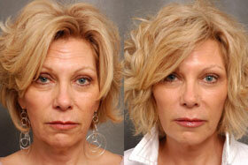 Photo 1 before and after application of Goji Cream