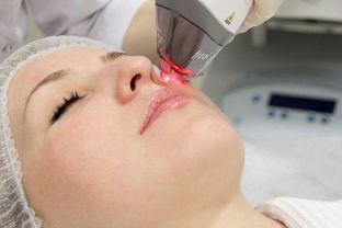 The process of facial skin rejuvenation with fractional laser