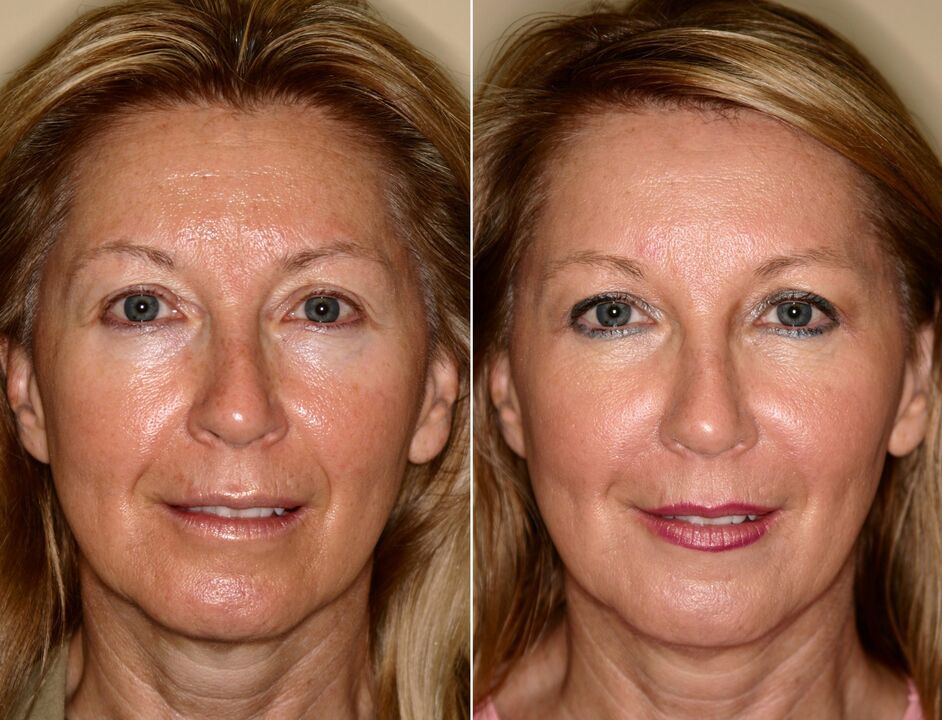 before and after using the rejuvenating massager ltza photo 5