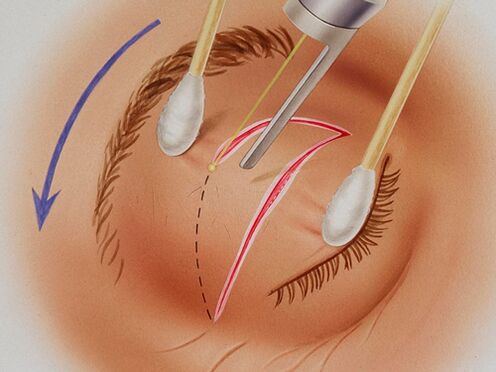 laser eyelid rejuvenation
