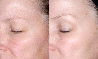 skin rejuvenation around the eyes before and after photos