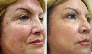 partial skin rejuvenation before and after photos