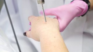 Laser skin rejuvenation of the hands