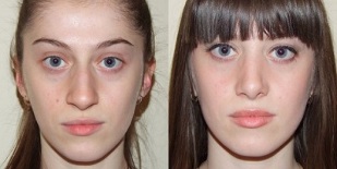 before and after plasma skin renewal